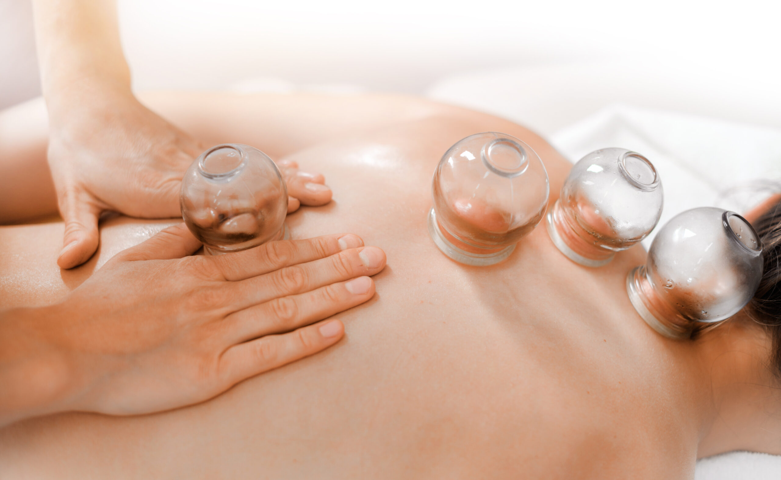 Cupping therapy east melbourne scaled