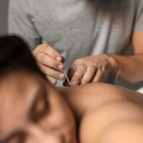 Acupuncture